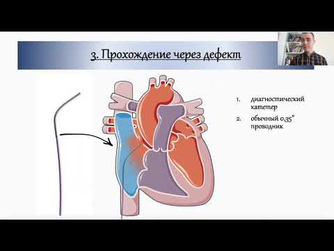 Видео: Хирургические нюансы имплантации окклюдера ДМПП