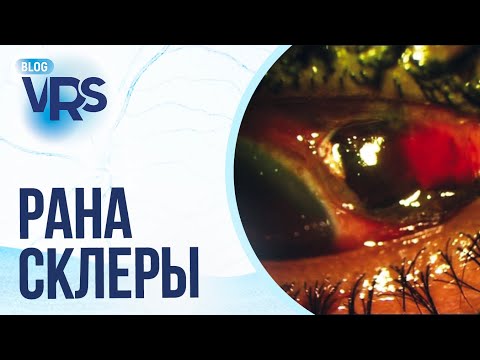 Видео: Травма глаза / Рана склеры