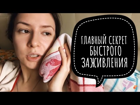 Видео: УДАЛИЛИ ЗУБЫ МУДРОСТИ | сложное удаление ретинированной восьмерки |  ЧТО ДЕЛАТЬ ПОСЛЕ? ЧТО ЕСТЬ?