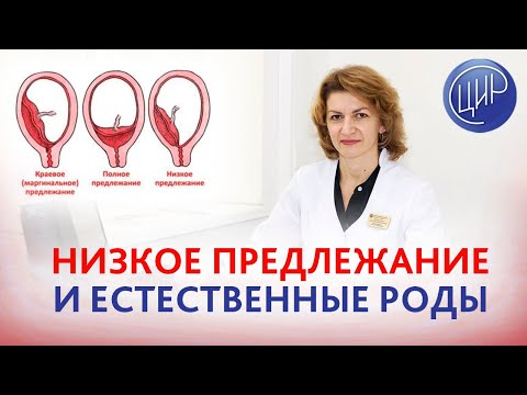 Видео: Низкое предлежание плаценты. Возможны ли естественные роды? Дементьева С.Н.