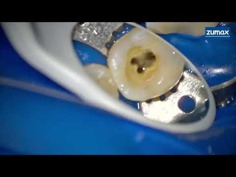 Видео: Каналы зуба в микроскопе стоматологоическом - обработка при периодонтите