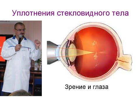 Видео: Уплотнения стекловидного тела. Их устранение.