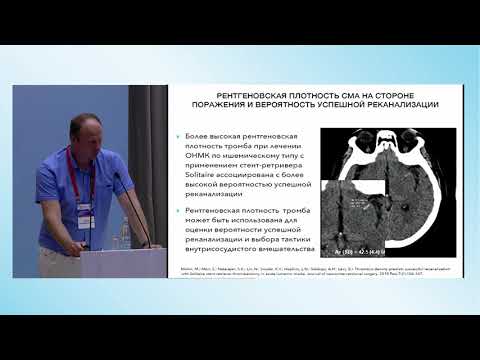 Видео: Сессия 4. Эндоваскулярная тромбоэкстракция у пациентов с И Н. Сложные и нерешенные вопросы