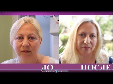 Видео: Пластика нижних и верхних век