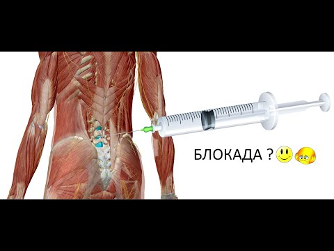 Видео: БЛОКАДА  для лечения грыжи диска, можно или нельзя? Доктор Борщенко объясняет