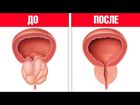 Видео: Пейте этот напиток каждый день, чтобы уменьшить простату🙌