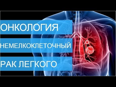 Видео: НЕМЕЛКОКЛЕТОЧНЫЙ РАК ЛЕГКОГО 1,2,3,4 стадии