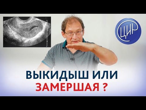 Видео: Выкидыш или замершая беременность? Чем отличается замершая беременность от выкидыша. Гузов И.И.