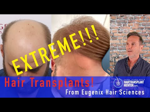 Видео: Крайние случаи выпадения волос были решены