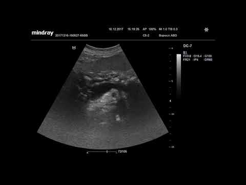 Видео: Ультразвуковая диагностика (УЗИ). Доктор Иогансен. Видеопримеры. Выпуск 43. Хронический панкреатит.