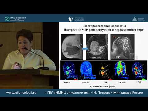 Видео: Лучевая диагностика мультицентричных/мультифокальных форм РМЖ