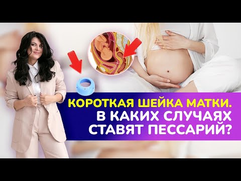 Видео: КОРОТКАЯ ШЕЙКА МАТКИ. ⭕В каких случаях ставят пессарий? I Укорочение шейки матки