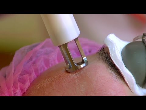 Видео: Как БЕЗОПАСНО УДАЛИТЬ РУБЦЫ после прыщей / Лазерная наноперфорация