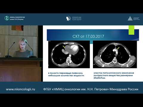 Видео: Опыт применения эрибулина в условиях реальной клинической практики