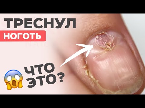Видео: Треснул ноготь | Последствия САМОМАНИКЮРА | Не делай так!