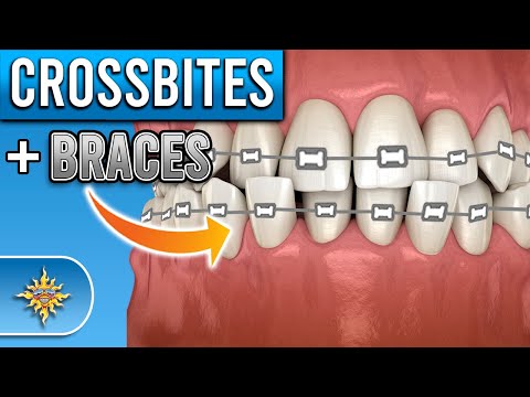 Видео: Как брекеты исправляют перекрестный прикус?