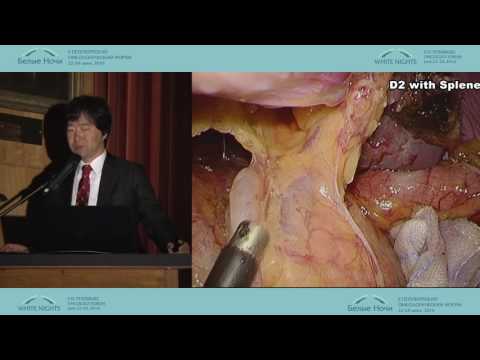 Видео: Современная хирургия рака желудка в Японии