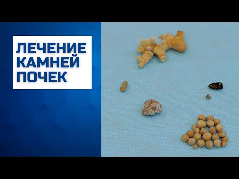 Видео: Лечение камней почек в Москве | Контактная уретеролитотрипсия и перкутанная нефролитотрипсия