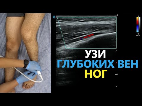 Видео: УЗИ Глубоких Вен Нижней Конечности с демонстрацией датчика. Пишем ПРОТОКОЛ вместе.