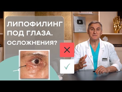 Видео: ЛИПОФИЛИНГ ПОД ГЛАЗА 👁 УБРАТЬ СИНЯКИ ПОД ГЛАЗАМИ  👁 ЕСТЬ ЛИ ОСЛОЖНЕНИЯ?