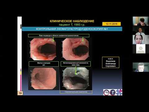 Видео: 2. Пирогов С.С., Беляева Т.В. Рак пищевода Барретта у пациента 25 лет:   клиническое наблюдение