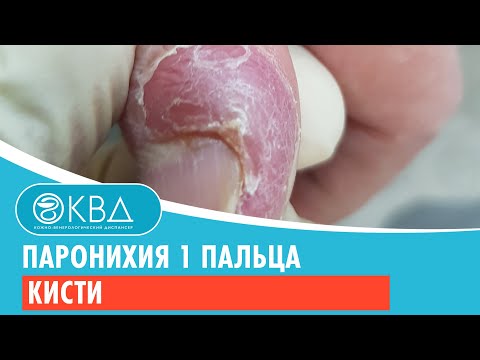 Видео: 😐 Паронихия 1 пальца кисти. Клинический случай №276