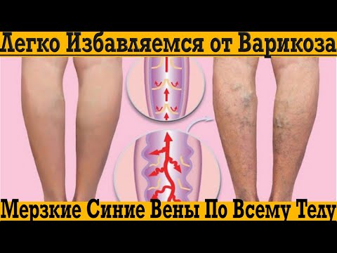 Видео: Достал ВАРИКОЗ?! Легко избавляемся от мерзких синих вен по всему телу с этим секретом!