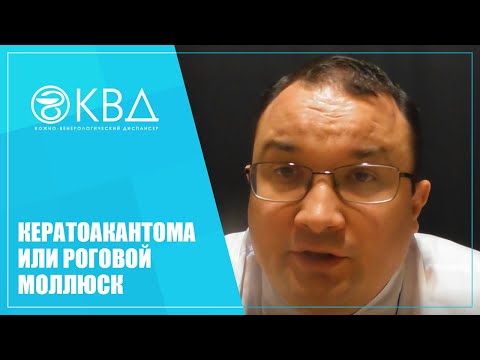 Видео: 1328  Кератоакантома или роговой моллюск