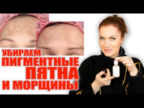 Видео: Убираем пигментные пятна и морщины! Самые сильные средства! 💥💥💥