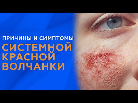 Видео: ПРИЧИНЫ И СИМПТОМЫ СИСТЕМНОЙ КРАСНОЙ ВОЛЧАНКИ // #zdravclinic
