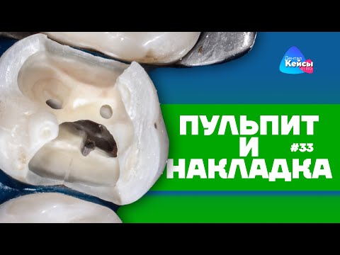 Видео: Пульпит и накладка | Дентал Кейсы от BG #33