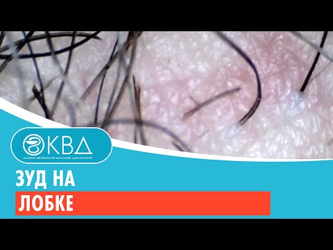 Видео: Зуд на лобке. Клинический случай №62