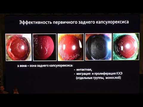 Видео: Первичный задний капсулорексис