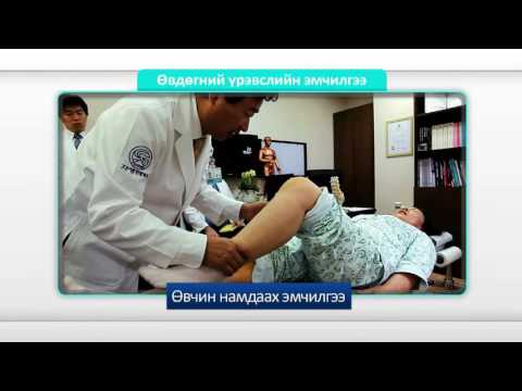 Видео: "Часэн эмнэлэг" Өвдөгний үе мөчний үрэвслийн эмчилгээ