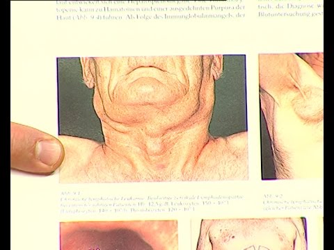 Видео: Лимфоми - видове диагностика и лечение