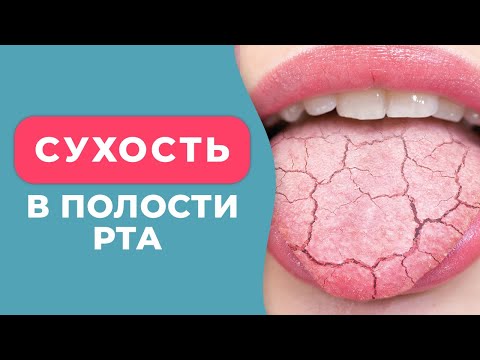 Видео: Почему появляется СУХОСТЬ ВО РТУ и как с этим бороться? / КСЕРОСТОМИЯ полости рта