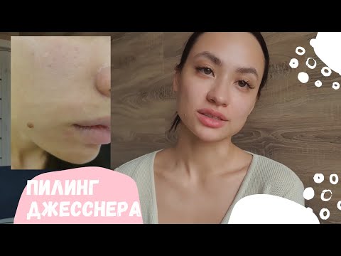 Видео: Пилинг Джесснера (Jessner peeling) Ожидание/реальность