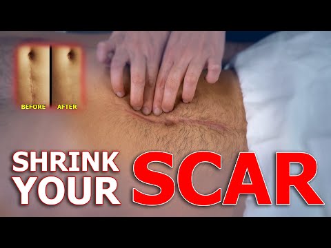 Видео: Болезненный или некрасивый шрам? Уменьшите шрам с помощью этого простого массажа рубцовой ткани |...