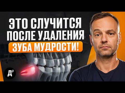 Видео: ЗУБЫ МУДРОСТИ: Когда их нужно удалять? Что будет после удаления? Скорее смотри!