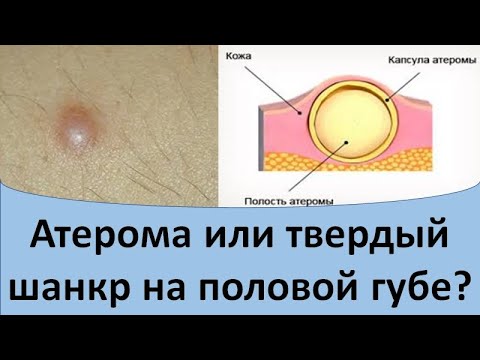 Видео: Твердый шанкр или атерома на половой губе?