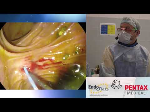 Видео: Эндоскопическое стентирование холедоха. С. В. Кашин, Д. В. Гусев, Е. Л. Тарасова