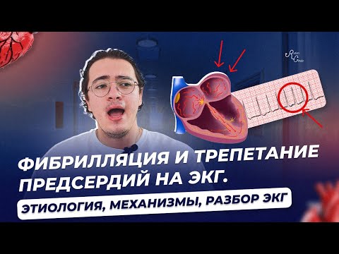 Видео: Фибрилляция и трепетание предсердий на ЭКГ  Этиология, механизмы, разбор ЭКГ