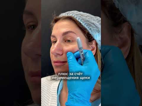 Видео: Эндоскопический лифтинг верхней и средней трети лица