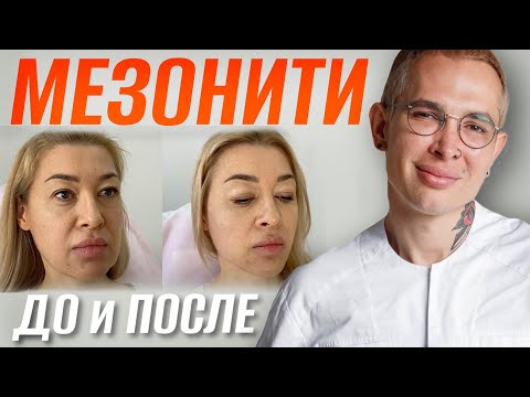 Видео: МЕЗОНИТИ ДО и ПОСЛЕ | Ставим Нити COG, мгновенная подтяжка лица #мезонити #подтяжкалица