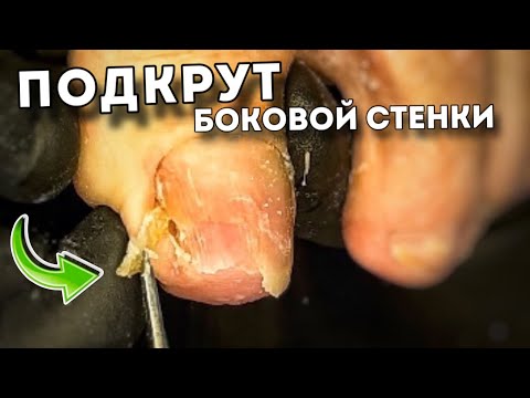 Видео: Скрученная боковая стенка ногтя вросла в ногтевое ложе