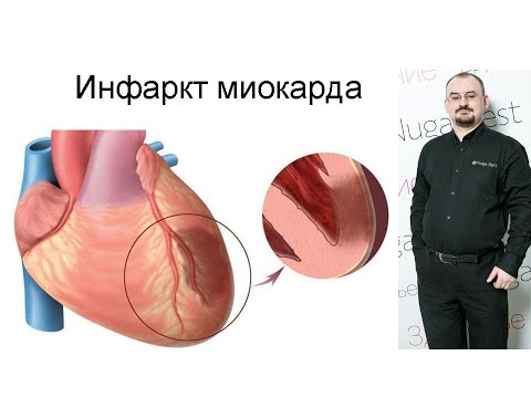 Видео: Инфаркт миокарда – проявление и лечение.