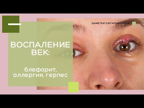 Видео: ВОСПАЛЕНИЕ ВЕК: опухоль, аллергия, ячмень, блефариты, герпес