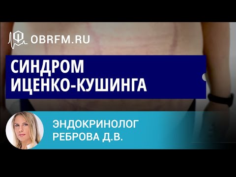 Видео: Эндокринолог Реброва Д.В.: Синдром Иценко-Кушинга