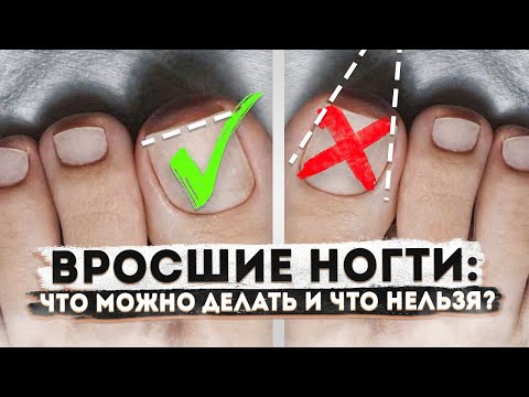 Видео: КАК ПРЕДОТВРАТИТЬ ВРАСТАНИЕ НОГТЕЙ? ПРОФИЛАКТИКА | Мнение подолога