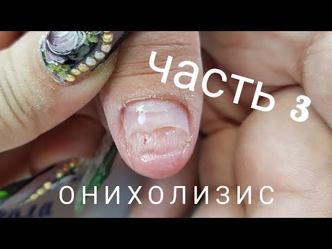 Видео: Онихолизис - часть третья/Продолжаем лечение травмированных ноготков/Шулунова Дарья